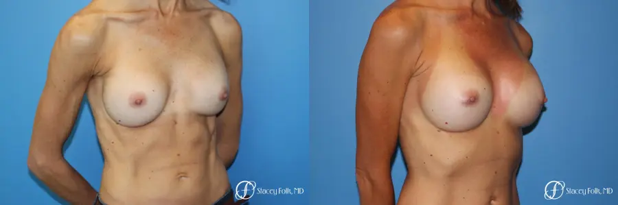 Denver Breast Revision 8504 - Before and After 2