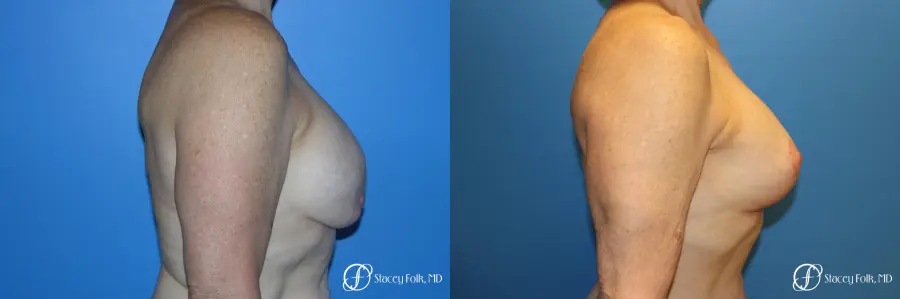 Denver Breast Revision 7990 - Before and After 4