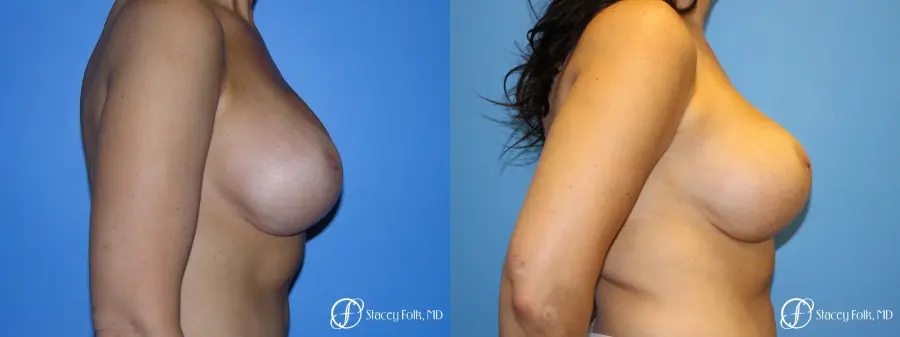Denver Breast Revision 10094 - Before and After 5