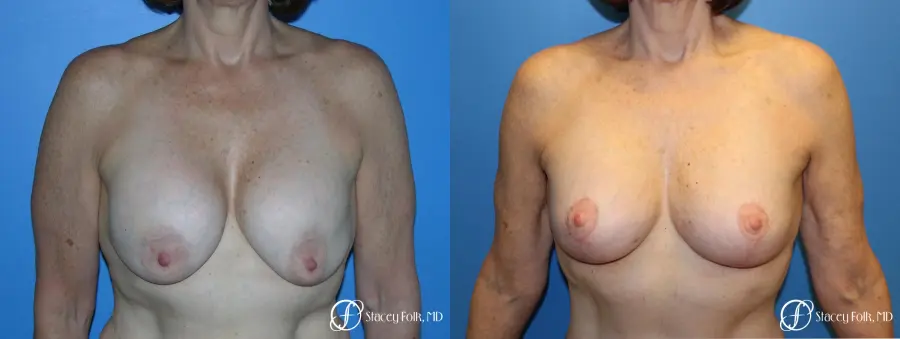 Denver Breast Revision 7990 - Before and After