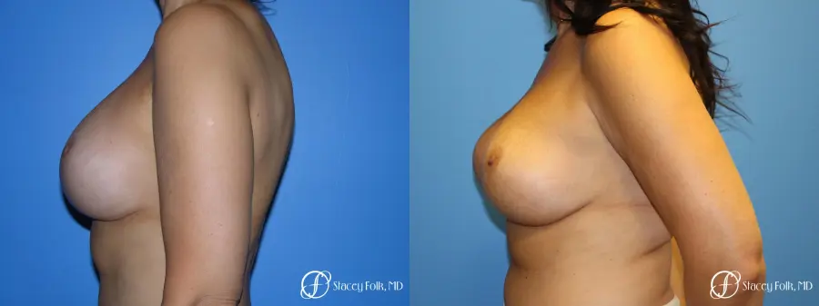 Denver Breast Revision 10094 - Before and After 4