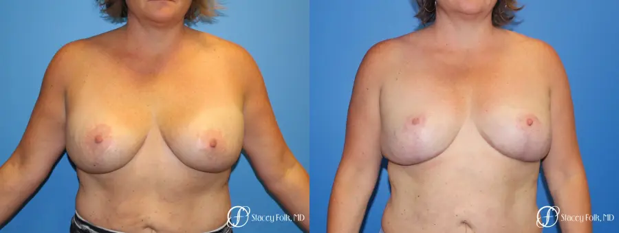 Breast Revision - Removal of Implant, Fat Transfer, Breast Lift (Mastopexy) - Before and After