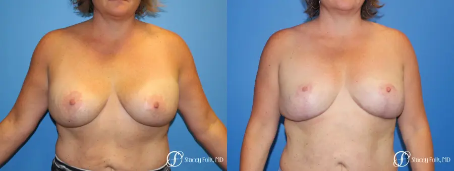 Breast Revision - Removal of Implant, Fat Transfer, Breast Lift (Mastopexy) - Before and After 1