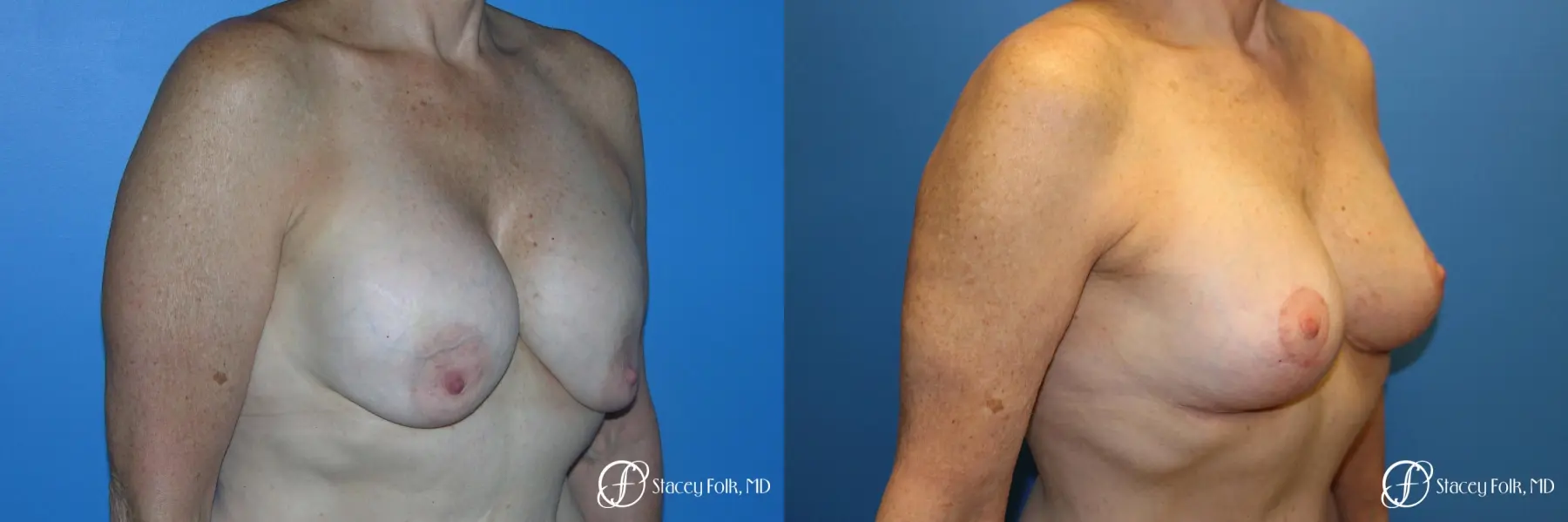 Denver Breast Revision 7990 - Before and After 2