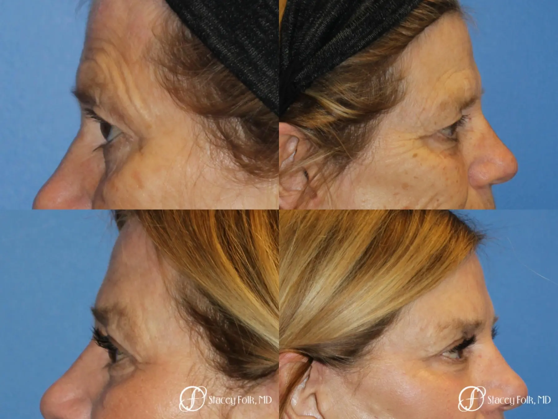 Denver Browlift and Blepharoplasty 11238 - Before and After 2