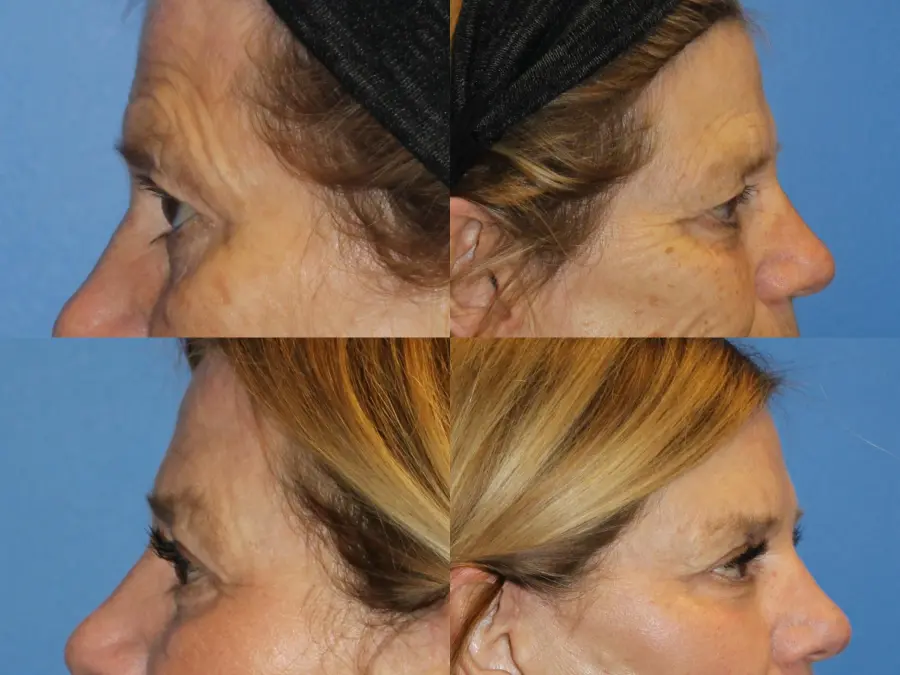 Denver Browlift and Blepharoplasty 11238 - Before and After 2