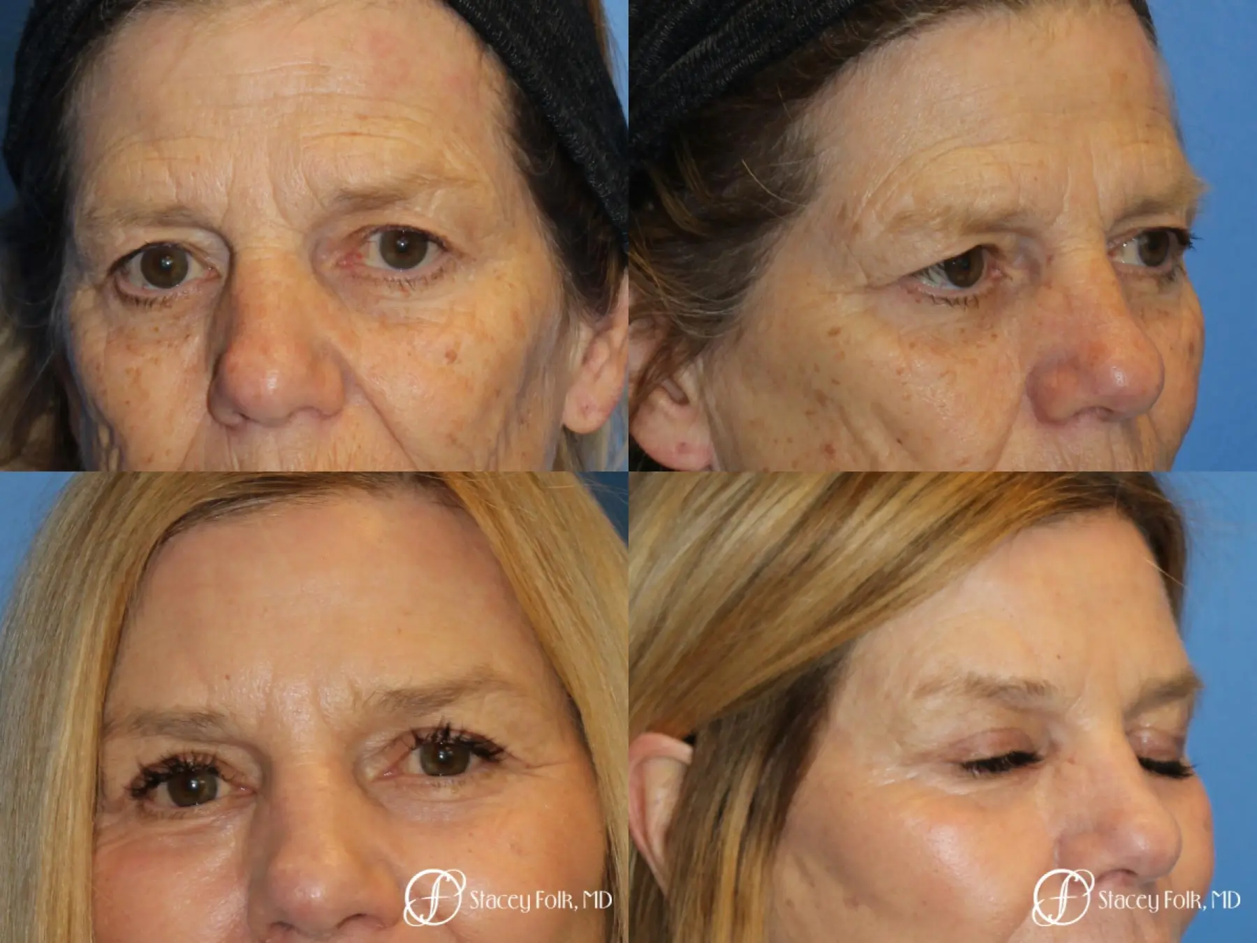 Denver Browlift and Blepharoplasty 11238 - Before and After