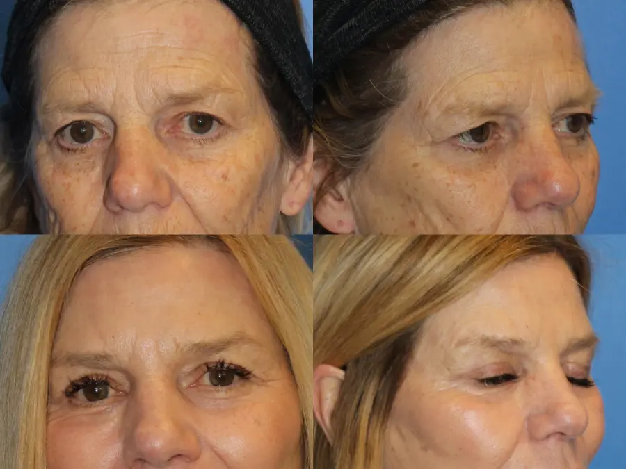 Denver Browlift and Blepharoplasty 11238 - Before and After 1