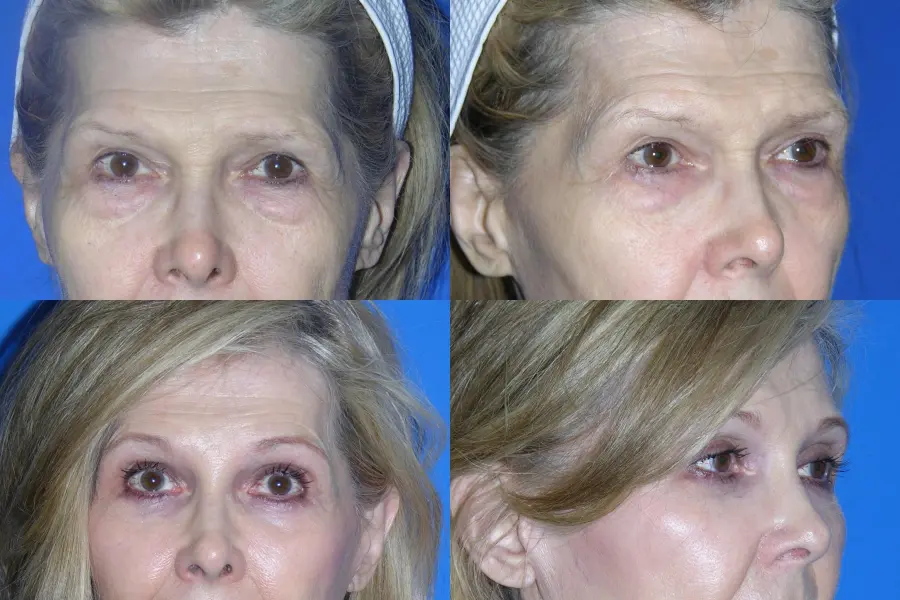 Denver Brow lift, Upper Blepharoplasty 7160 - Before and After 1