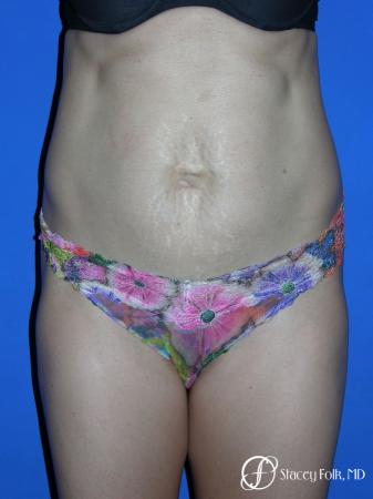 Denver Tummy Tuck Abdominoplasty 5456 - Before Image 1