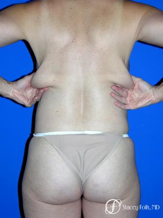 Denver Coolsculpting 8161 - Before and After Image 2
