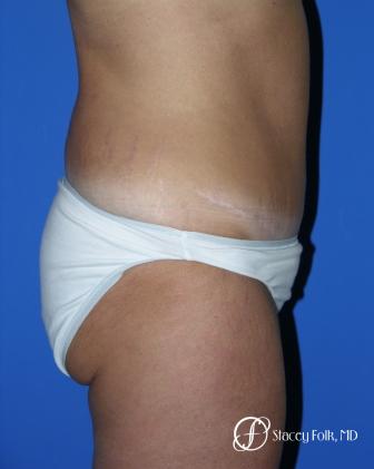 Denver Tummy Tuck 18 - After Image 2