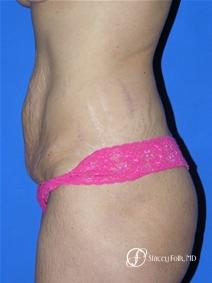Denver Tummy Tuck 19 - Before and After Image 2