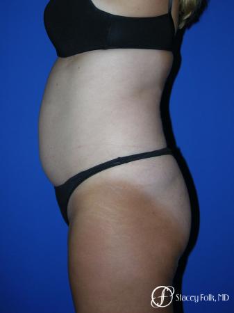 Denver Tummy Tuck - Abdominoplasty 53 - Before and After Image 2