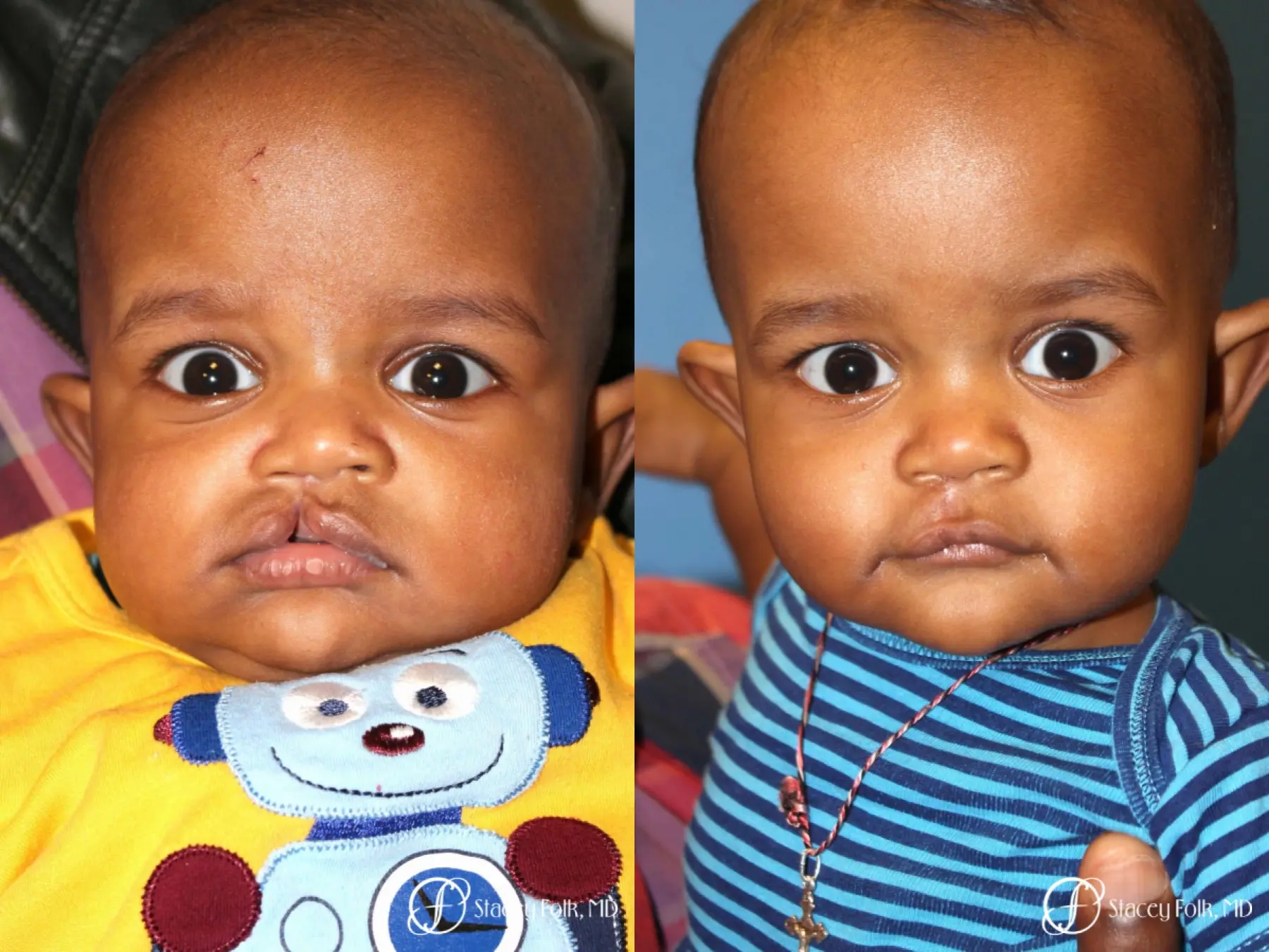 Denver Cleft lip repair 5934 - Before and After