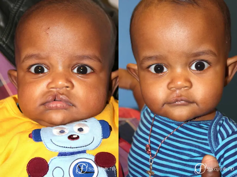 Denver Cleft lip repair 5934 - Before and After 1