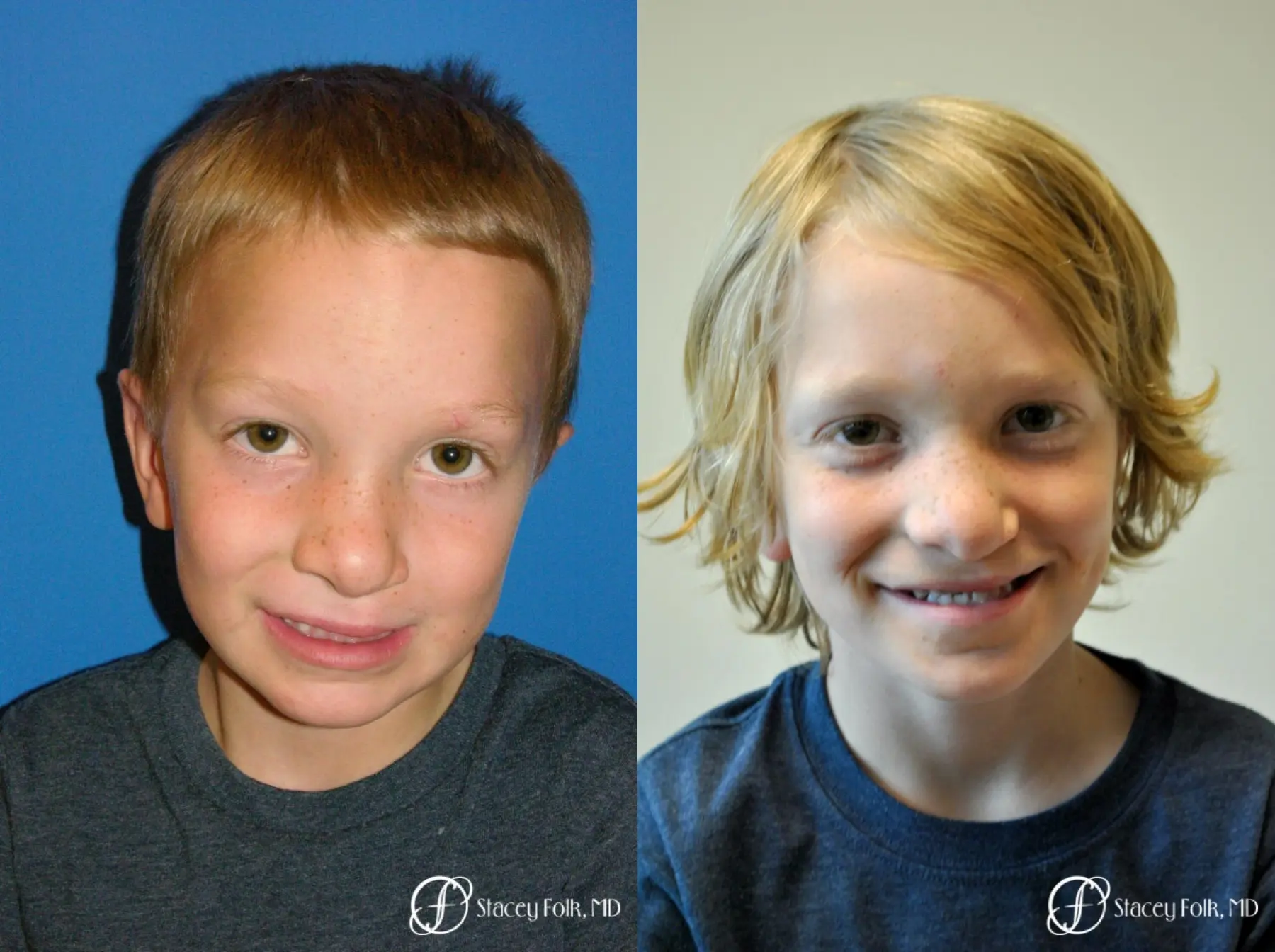 Denver Cleft Lip and Palate Repair 964 - Before and After 2