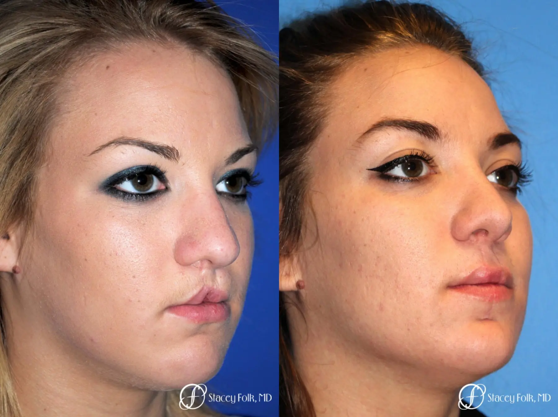 Denver Septorhinoplasty and Cleft Lip Repair 8162 - Before and After 3