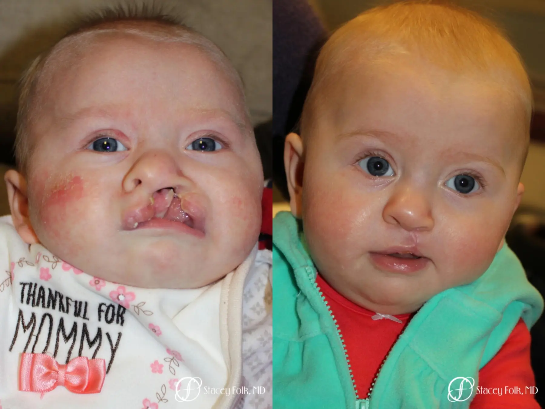 Denver Cleft lip and palate repair 9363 - Before and After 1