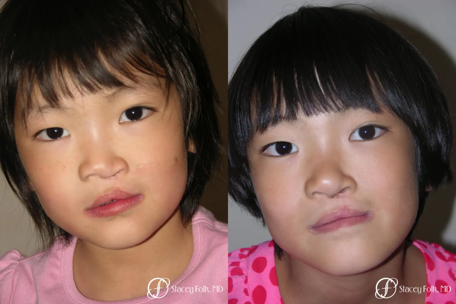Denver Cleft Lip and Palate Repair 59 - Before and After 2