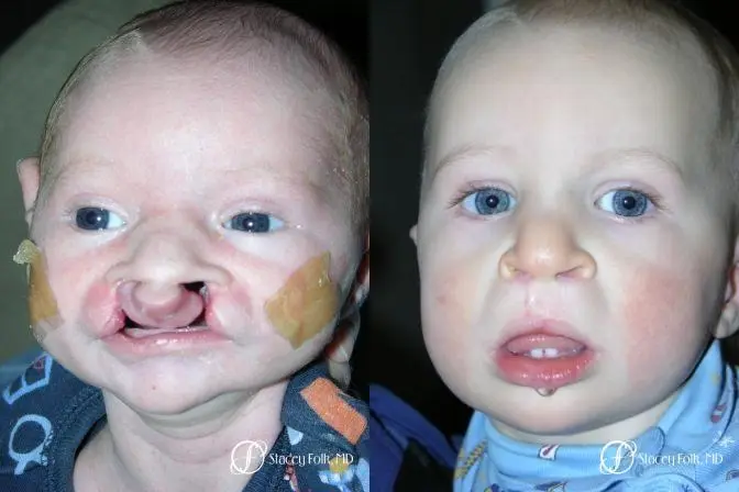 Denver Cleft Lip and Palate Repair 967 - Before and After 1