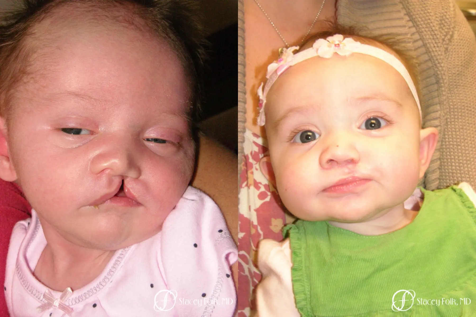 Denver Cleft Lip and Palate Repair 4776 - Before and After 1