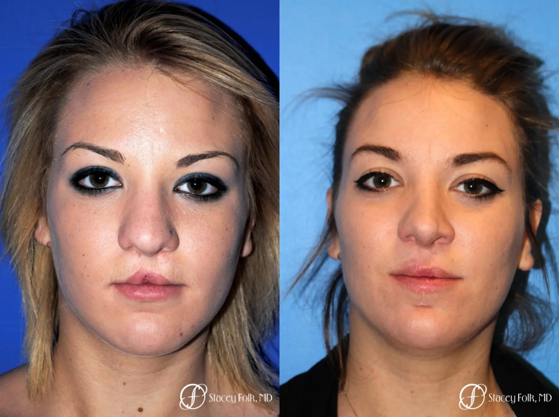 Denver Septorhinoplasty and Cleft Lip Repair 8162 - Before and After 1