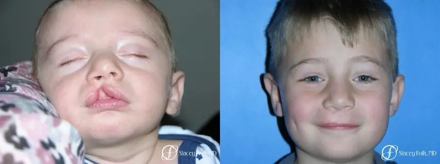 Denver Cleft Lip and Palate Repair 3304 - Before and After 1