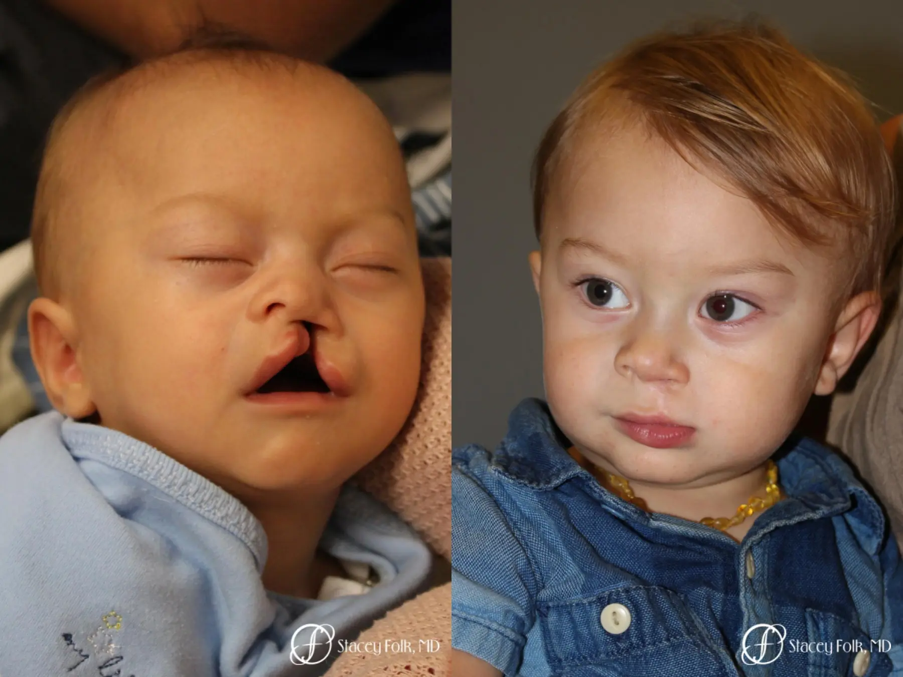 Denver Cleft Lip and Palate Repair 10314 - Before and After 1