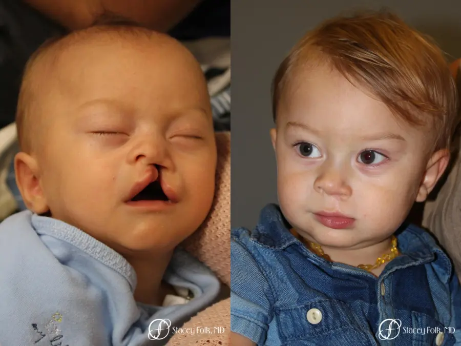 Denver Cleft Lip and Palate Repair 10314 - Before and After