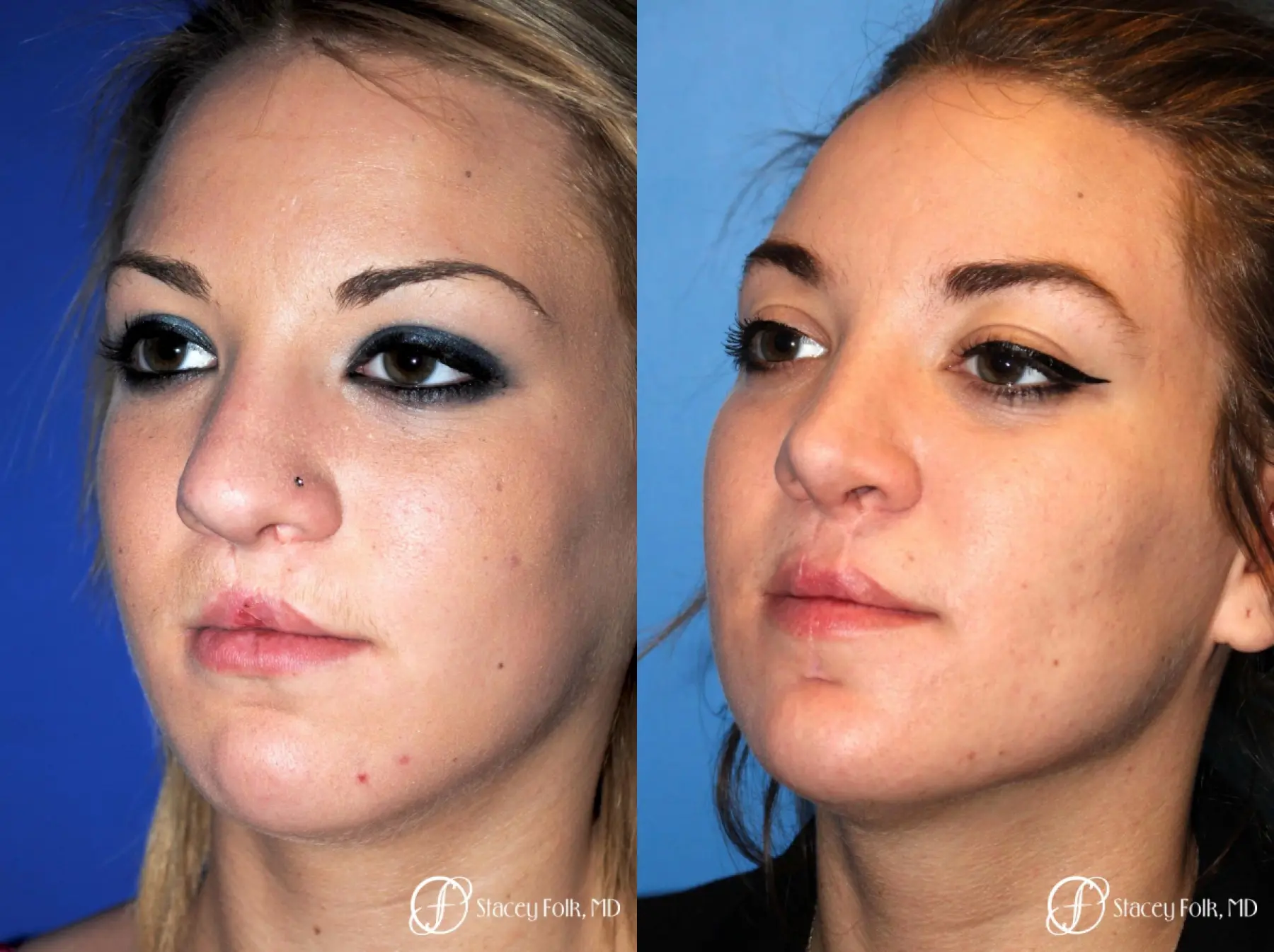 Denver Septorhinoplasty and Cleft Lip Repair 8162 - Before and After 2