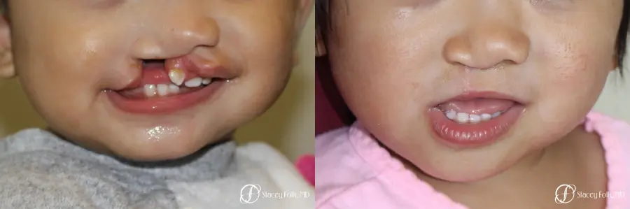 Denver Cleft Lip and Palate Repair 10315 - Before and After