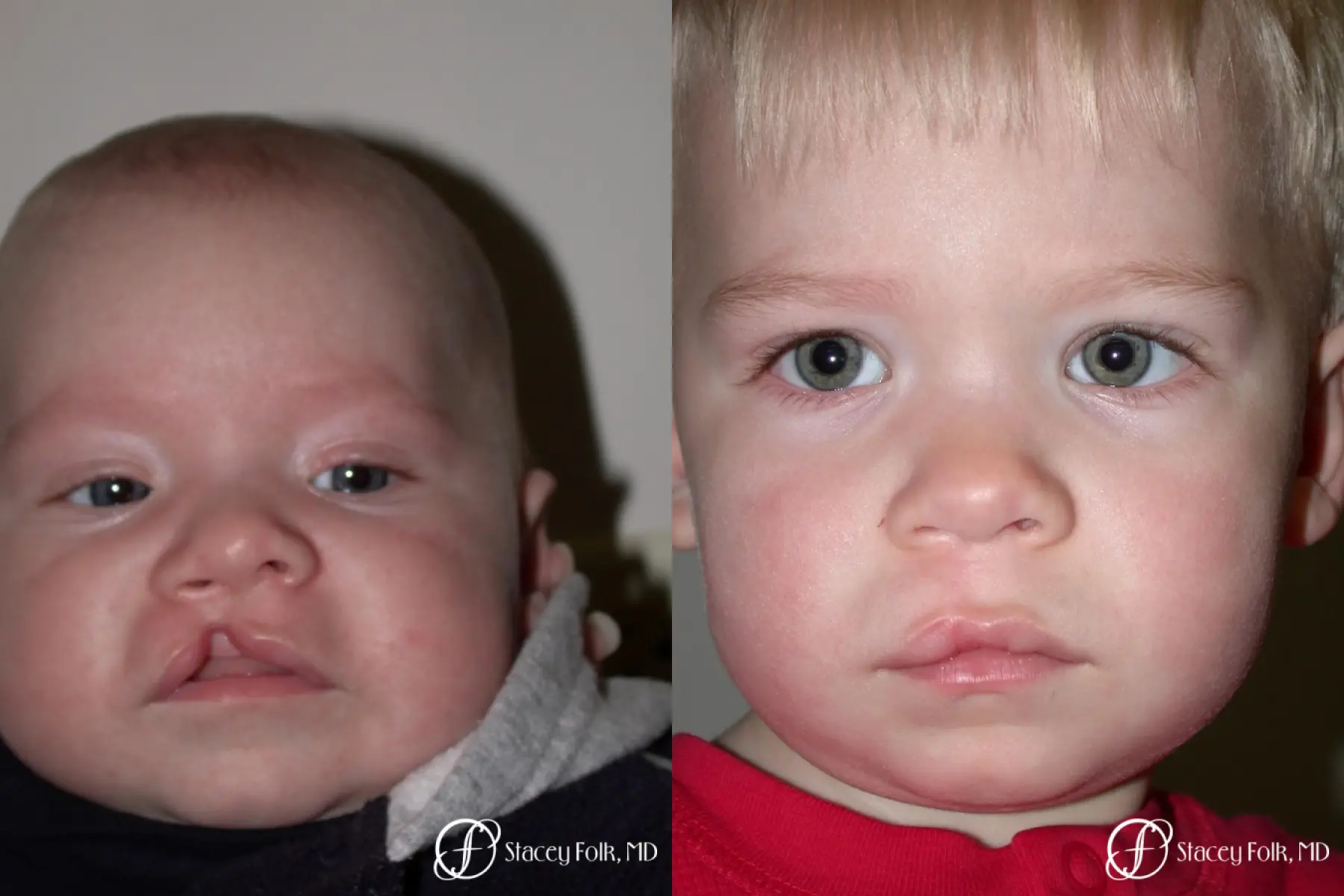 Denver Cleft Lip and Palate Repair 3305 - Before and After