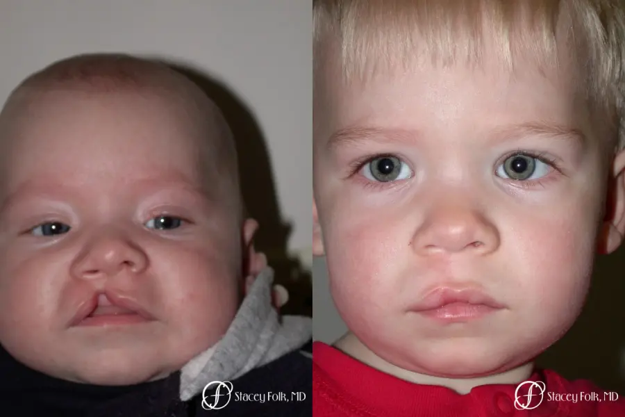 Denver Cleft Lip and Palate Repair 3305 - Before and After 1