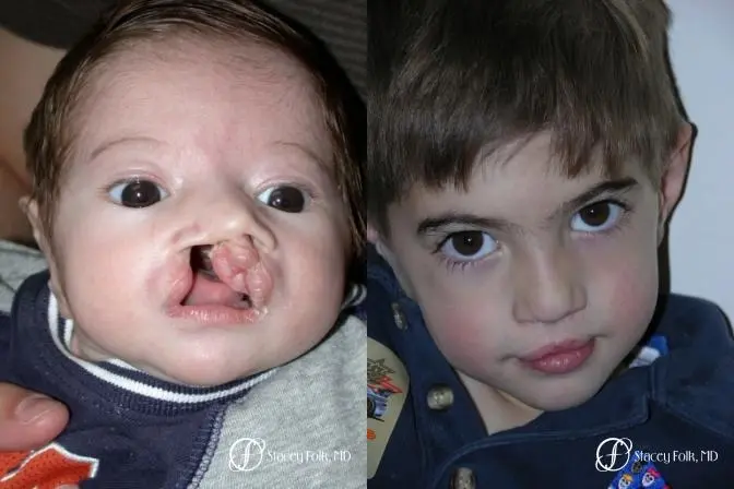 Denver Cleft Lip and Palate Repair 57 - Before and After 1
