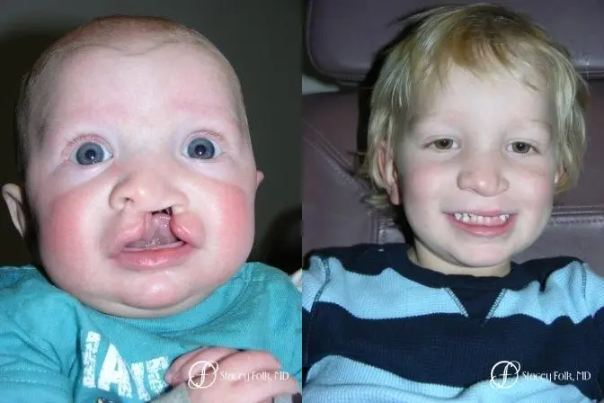 Denver Cleft Lip and Palate Repair 964 - Before and After
