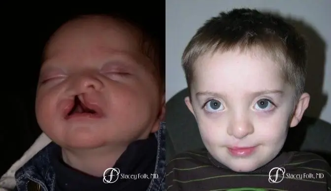 Denver Cleft Lip and Palate Repair 965 - Before and After