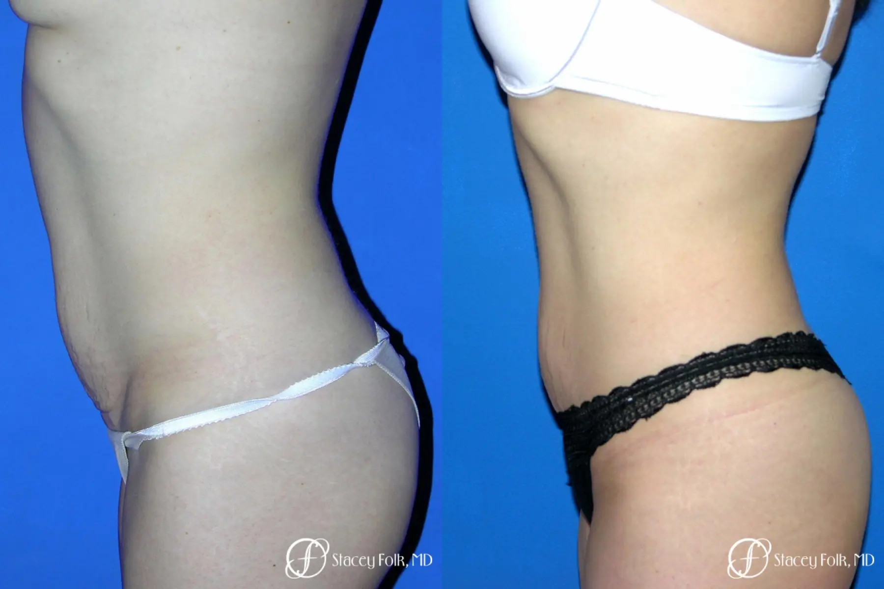 Denver Coolsculpting 8160 - Before and After 2
