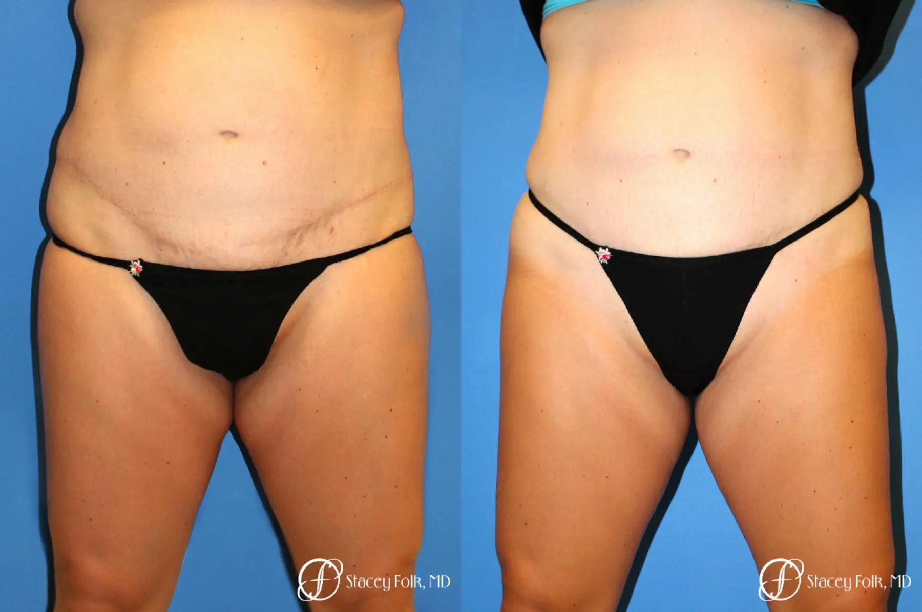 Denver Coolsculpting 8157 - Before and After 1