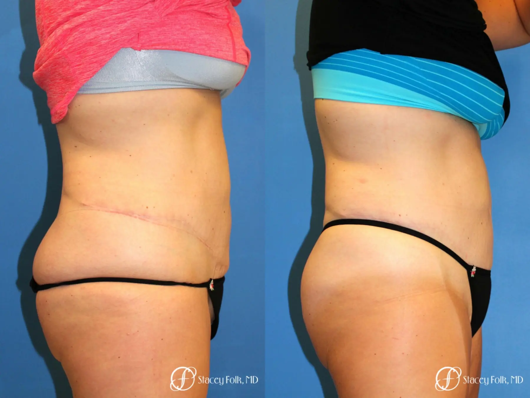Denver Coolsculpting 8157 - Before and After 2