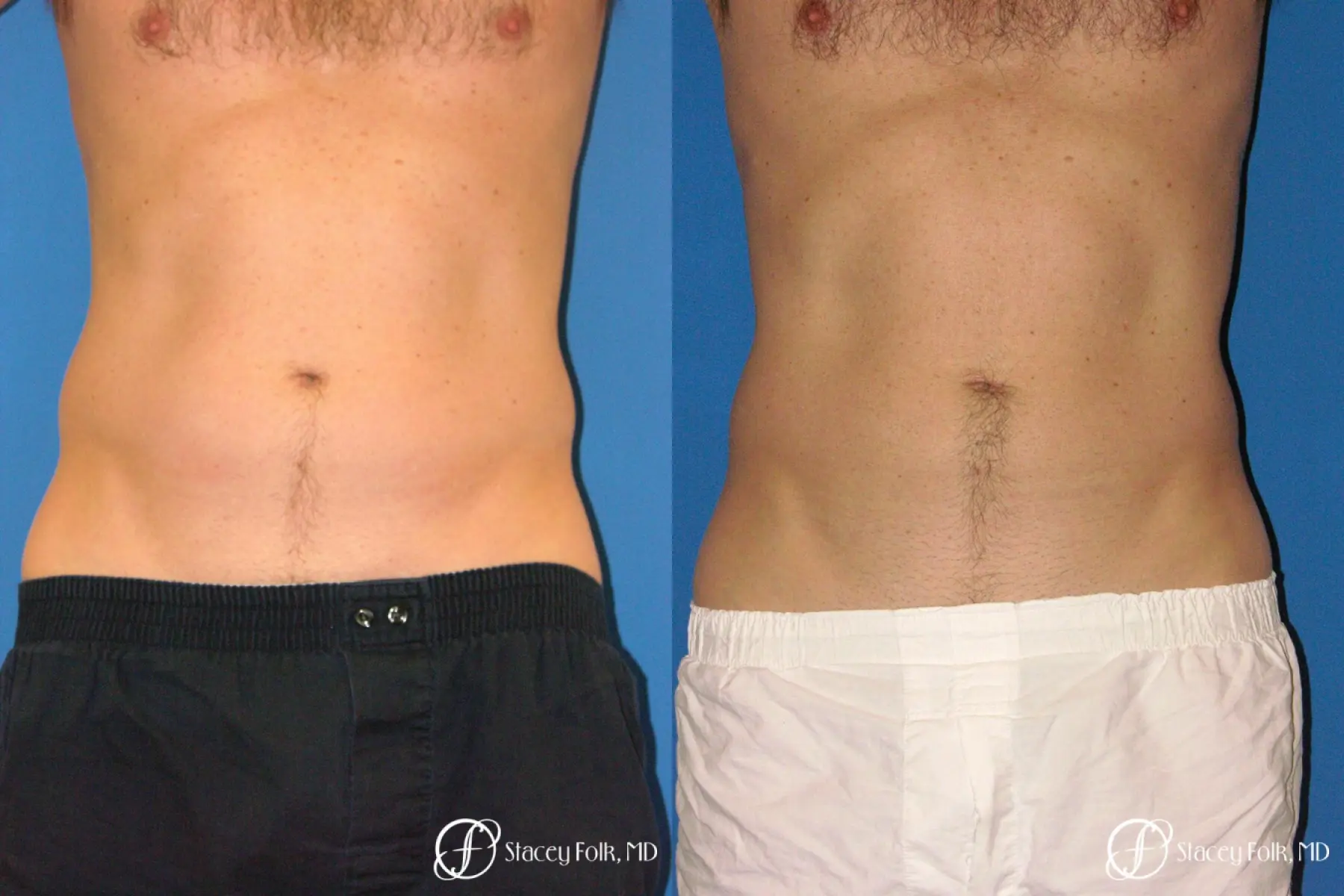Denver Coolsculpting 5970 - Before and After 1