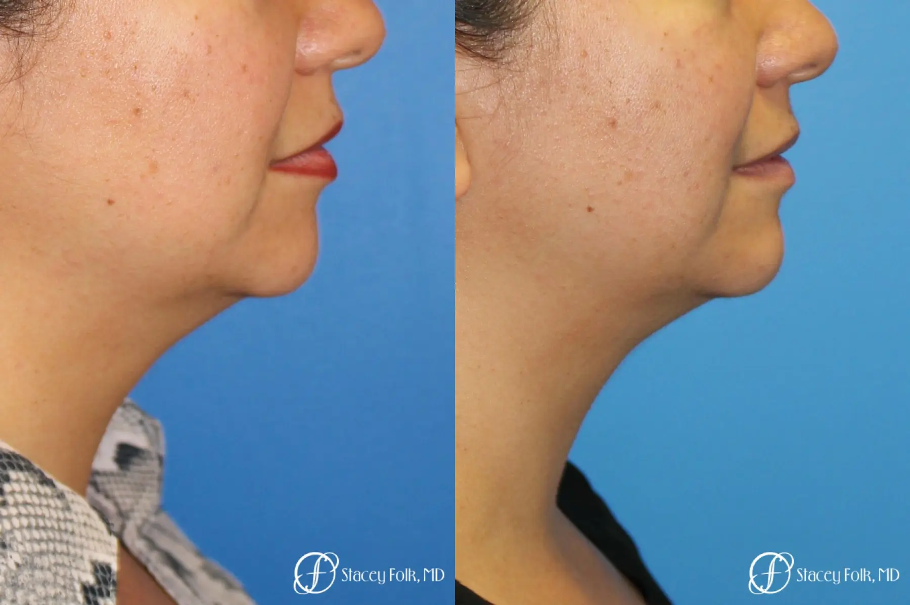 Denver CoolSculpting treatment of the double chin 8275 - Before and After 1