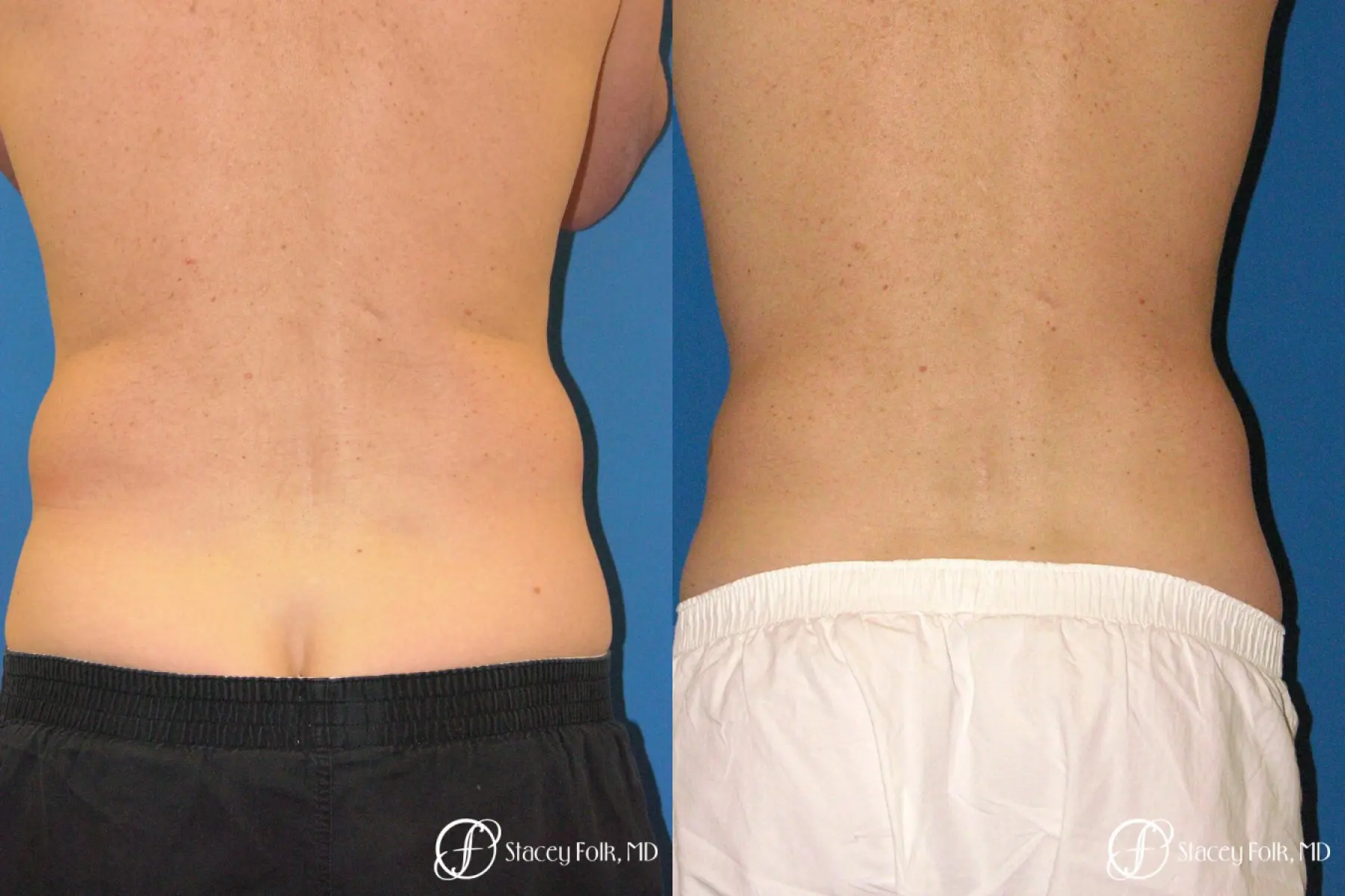 Denver Coolsculpting 5970 - Before and After 2