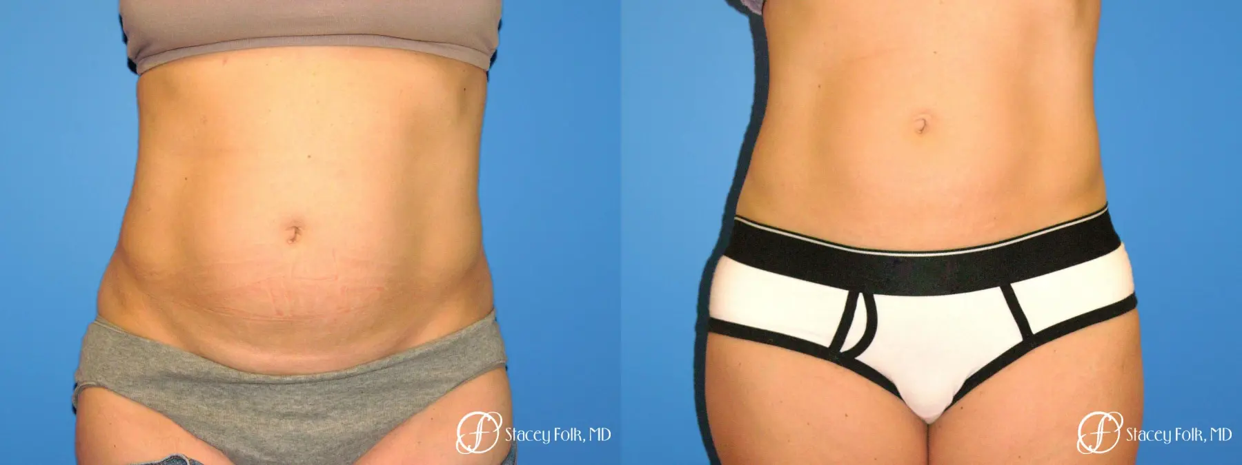 Denver Coolsculpting 8158 - Before and After 1