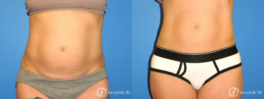 Denver Coolsculpting 8158 - Before and After