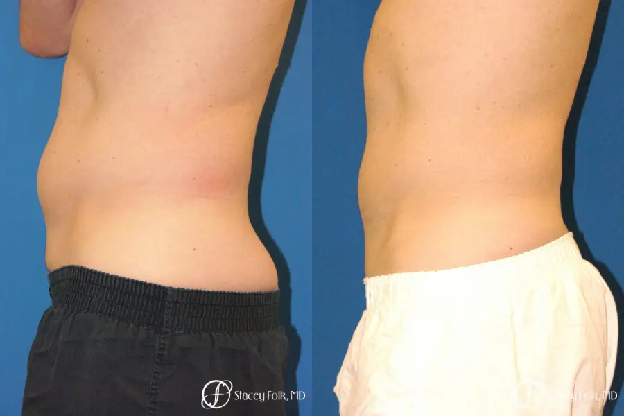 Denver Coolsculpting 5970 - Before and After 3