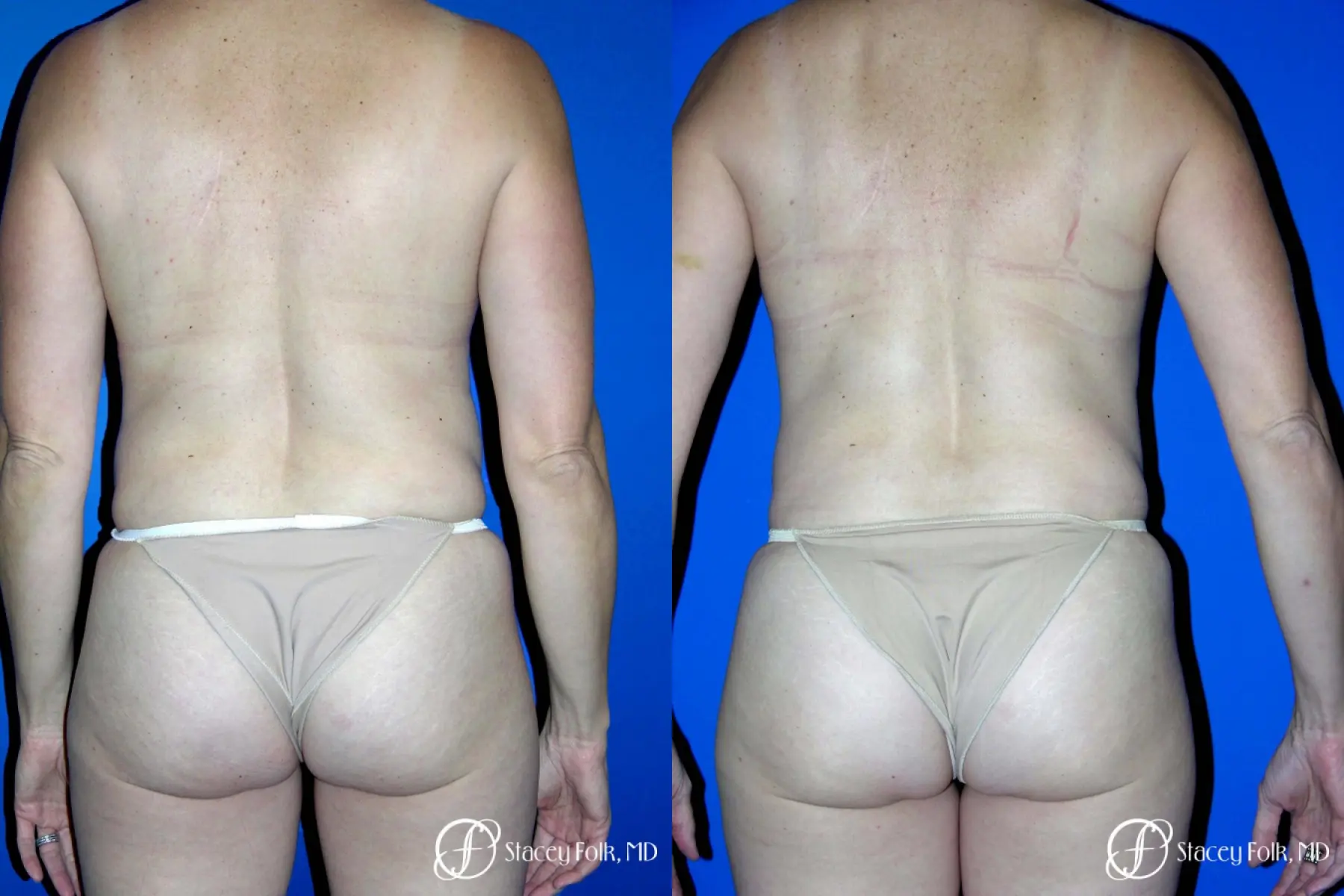 Denver Coolsculpting 8161 - Before and After
