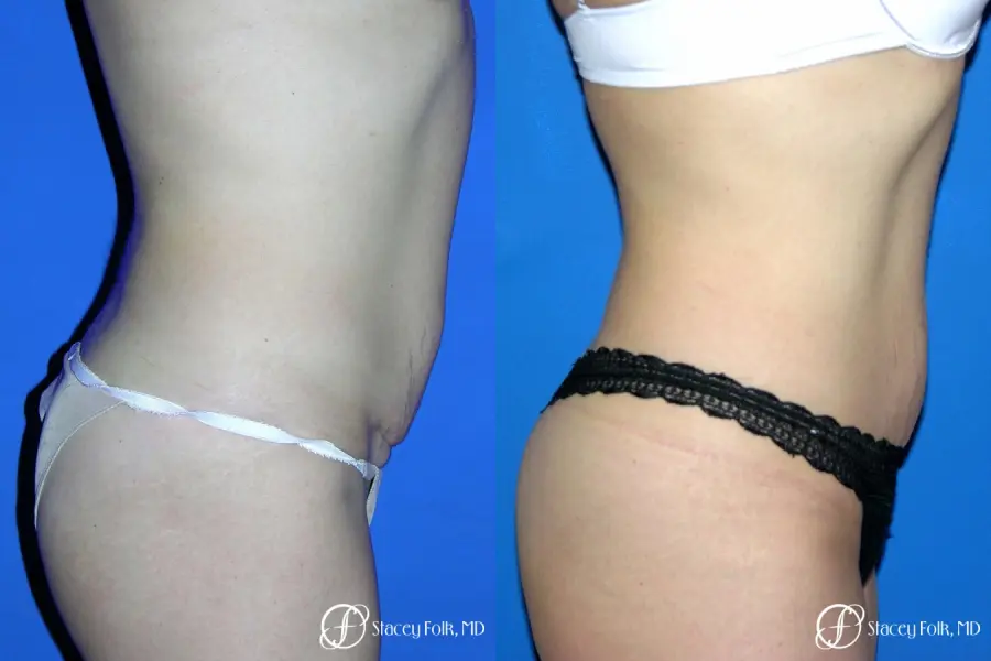 Denver Coolsculpting 8160 - Before and After 1