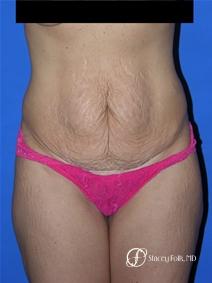 Denver Tummy Tuck 19 - Before Image 1