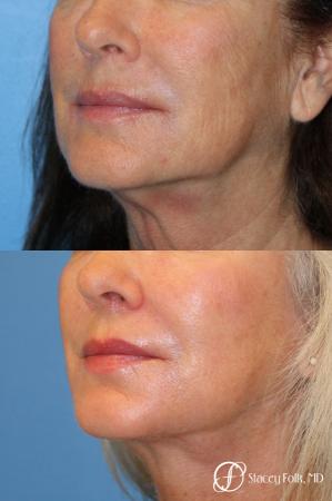 Denver Laser Skin Resurfacing Face 9390 - After Image 1